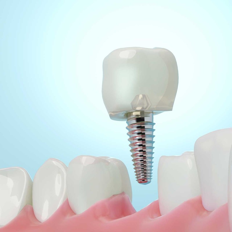 Quick Solution for Emergencies: Implants and Crowns in 1 Day